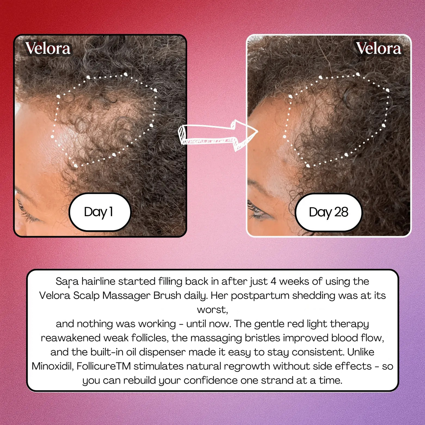 Velora Red Light Scalp Brush – Soothe & Strengthen Hair